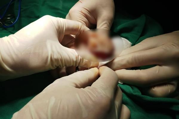 người đàn ông phải cắt cụt cậu nhỏ ảnh 1 nguoi dan ong phai cat cut cau nho anh 1