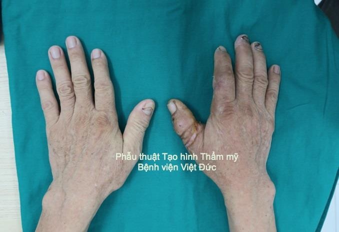 máy cưa cắt đứt rời ngón tay ảnh 1 may cua cat dut roi ngon tay anh 1