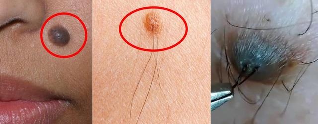 Nốt ruồi có lông  ảnh 1 Not ruoi co long anh 1