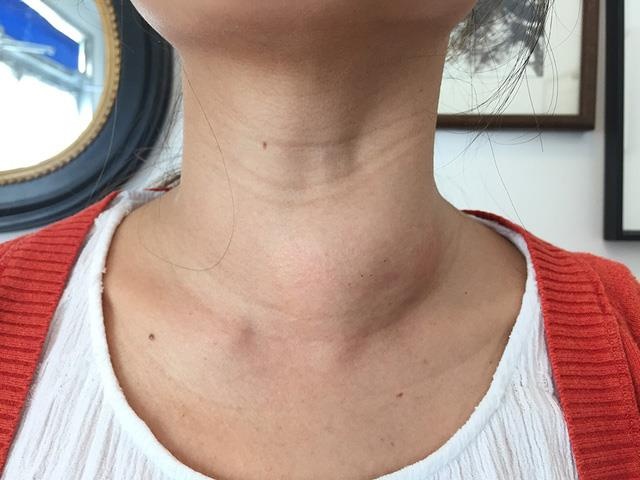 Phau thuat cat buou co nang hon mot kg hinh anh