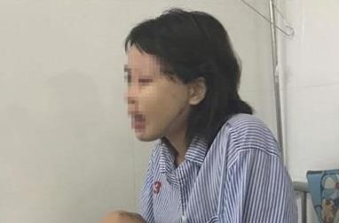 Vu co gai bi tat axit: Bac si am anh vi mot nua khuon mat chay den hinh anh