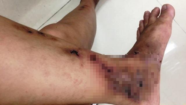 Ban chan thung lo cho vi can benh di ung nguy hiem hinh anh