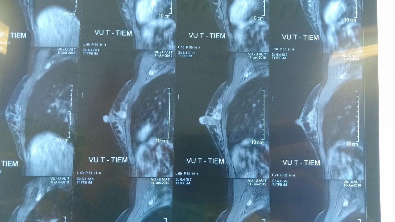 Cô gái chưa chồng sốc vì phát hiện mắc ung thư vú  ảnh 1 Co gai chua chong soc vi phat hien mac ung thu vu anh 1
