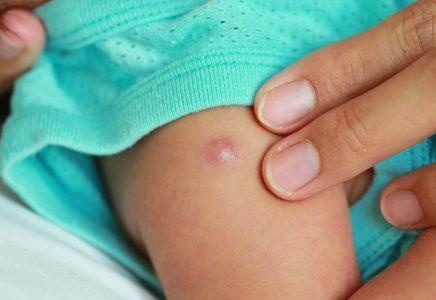 cha mẹ nặn nhọt ảnh 1 cha me nan nhot anh 1