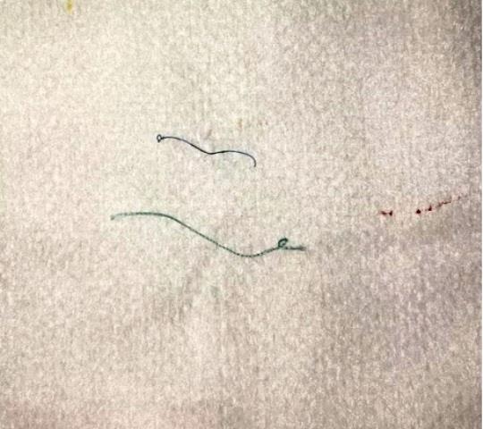 suýt mù mắt vì nhấn mí ảnh 1 suyt mu mat vi nhan mi anh 1