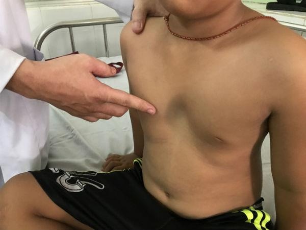 Tre bi viem phoi keo dai, can trong mac lom nguc bam sinh hinh anh