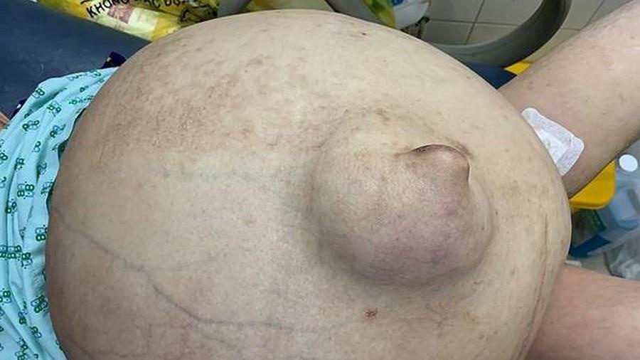 Thieu nu 19 tuoi 'be' khoi u khong lo, nang hon 50 kg hinh anh