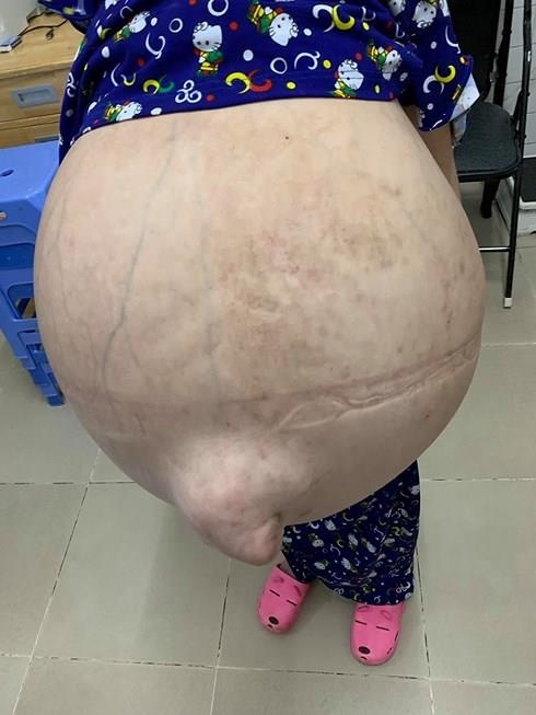 khối u khổng lồ ảnh 1 khoi u khong lo anh 1