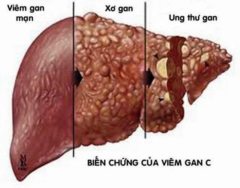 viem gan C anh 1
