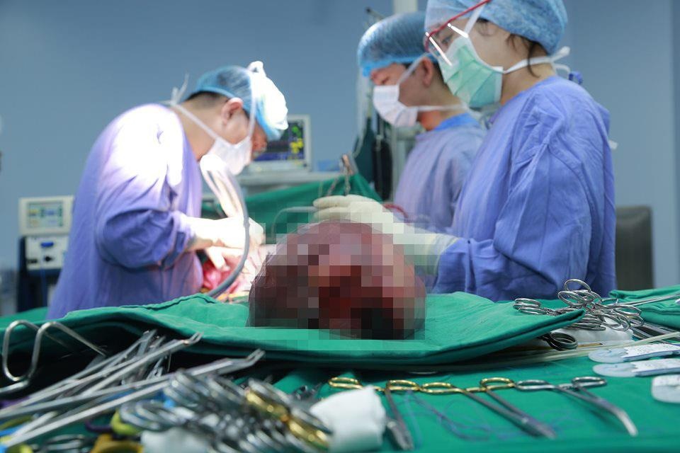 khối u gan khổng lồ ảnh 1 khoi u gan khong lo anh 1