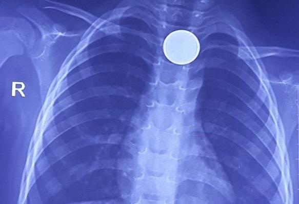 bé trai nuốt đồng xu vào bụng ảnh 1 be trai nuot dong xu vao bung anh 1