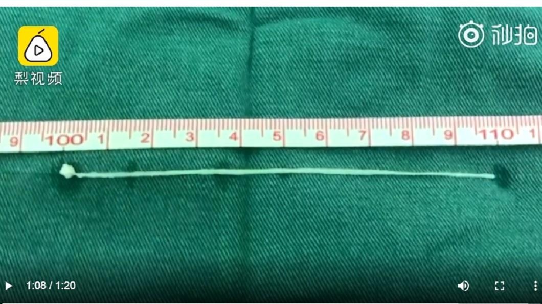 co giật 30 năm do sán ký sinh trong não ảnh 1 co giat 30 nam do san ky sinh trong nao anh 1