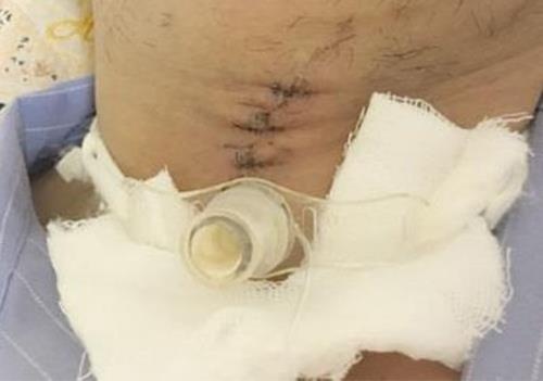 Bi da mai ban vao co, nguoi dan ong nhap vien cap cuu hinh anh