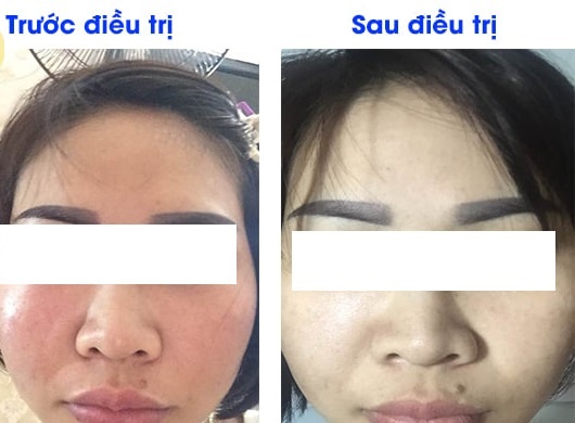 viem mat sau khi tri nam o spa anh 1