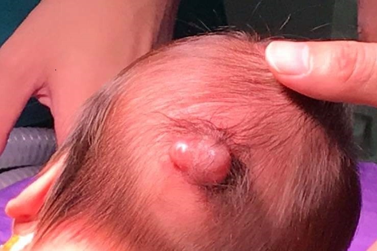 Be trai vua sinh ra da co khoi u sau dau hinh anh