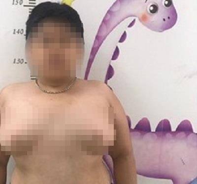 Be trai ram long, nguc no nhu con gai vi lam dung thuoc corticoid hinh anh
