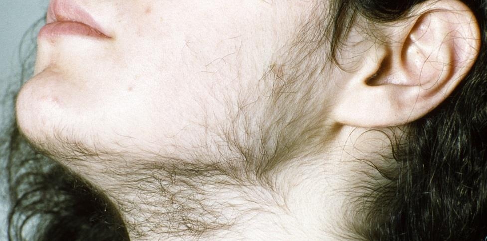 Ba thang tang 14 kg, than hinh 6 mui nghi do uong sua tron corticoid hinh anh