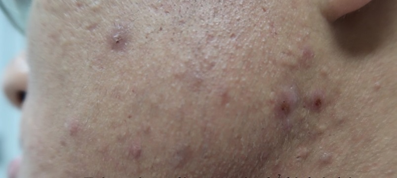 sữa trộn corticoid  ảnh 2 sua tron corticoid anh 2