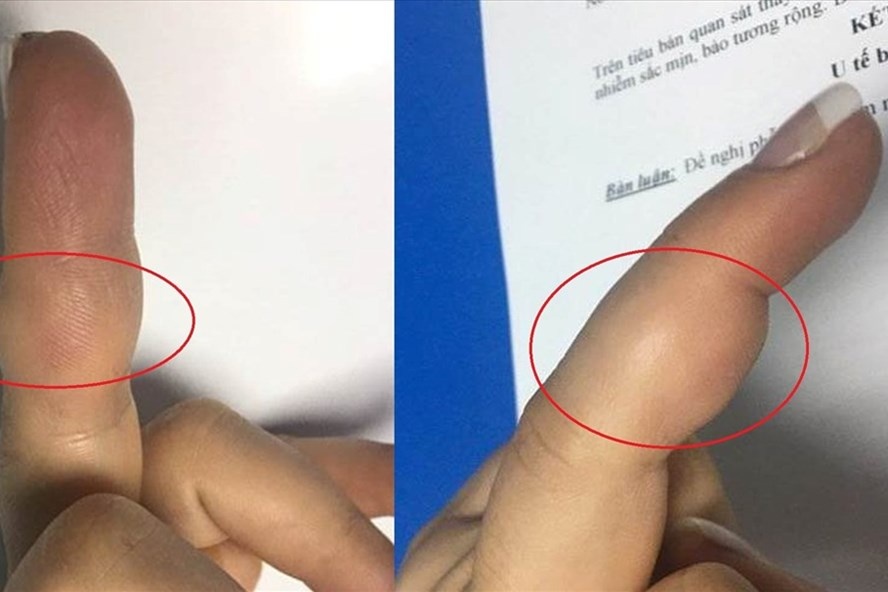 Ngon tay sung, can than bi u te bao khong lo hinh anh