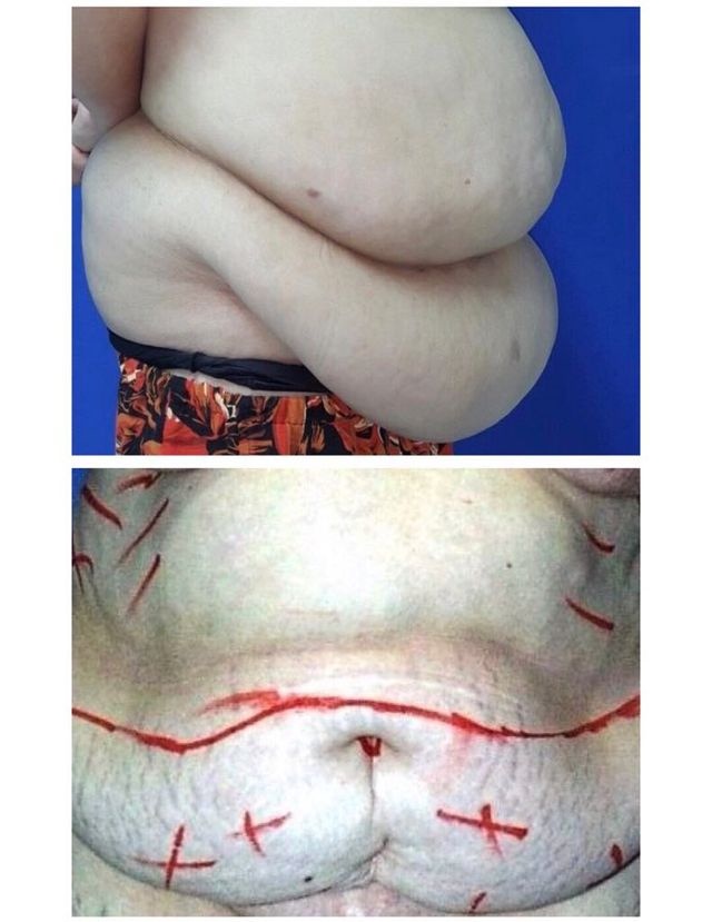 tao hinh vong bung anh 1