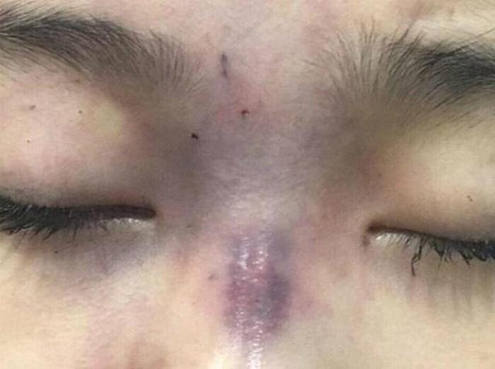 Be gai 13 tuoi mu mat vi tiem filler nang mui hinh anh