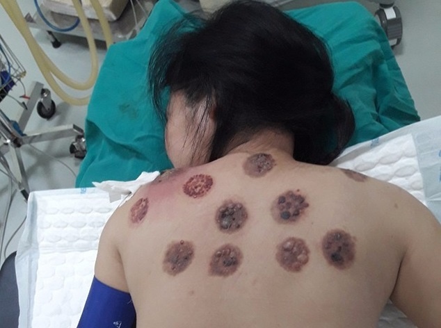 Lung nhiem trung, chay mau lan mu vi di giac hoi hinh anh