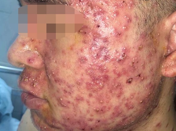 Mua thuốc trị mụn trên Facebook ảnh 1 Mua thuoc tri mun tren Facebook anh 1