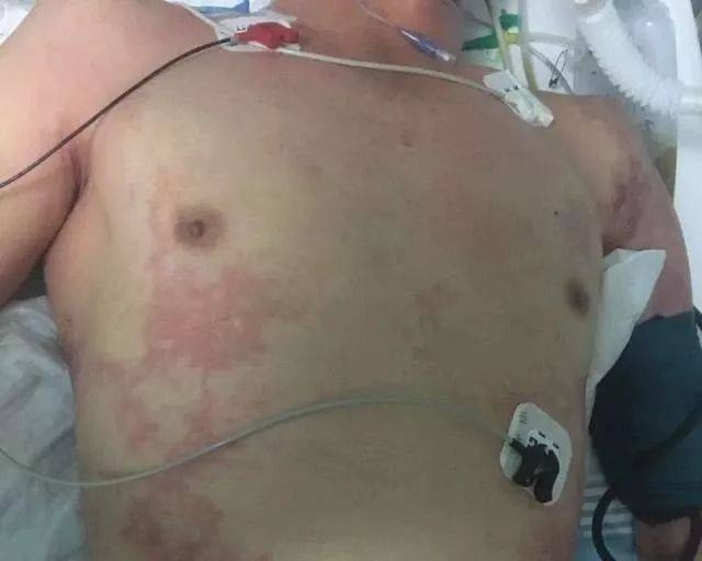 nhồi máu cơ tim ảnh 1 nhoi mau co tim anh 1