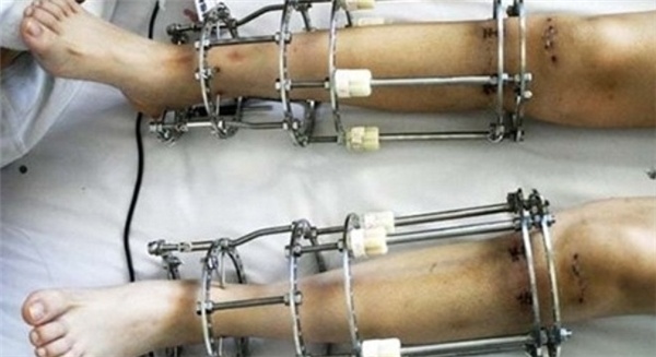 Phau thuat keo dai chan nhu the nao? hinh anh