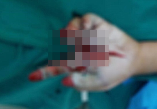 Be trai nhap vien do phao no hinh anh