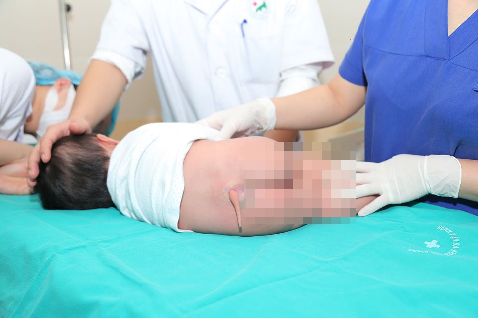 Bé gái ở Hà Nội có đuôi dài gần 10 cm ở mông ảnh 1 Be gai o Ha Noi co duoi dai gan 10 cm o mong anh 1