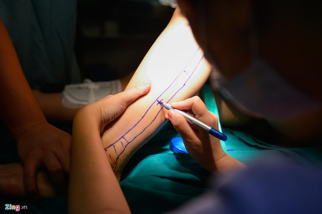 ung thu bieu mo san mieng xam lan
xuong ham duoi anh 2