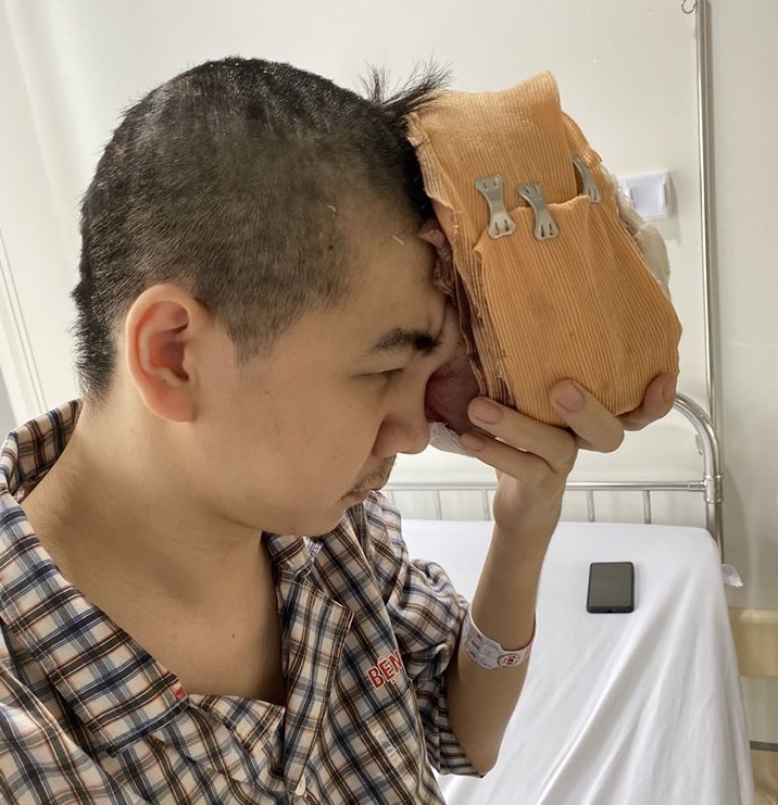 dung tay do khoi u khong lo tren mat anh 1