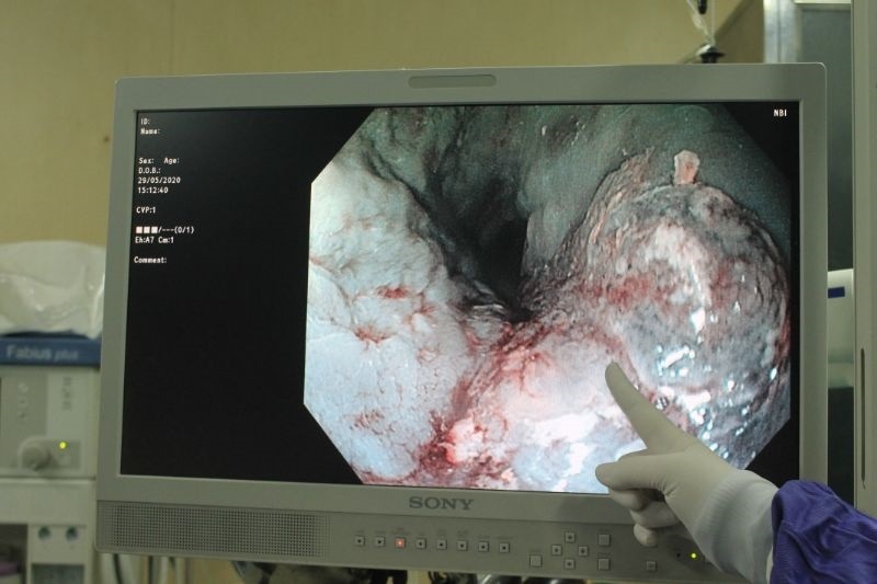 Phat hien ung thu thuc quan anh 1