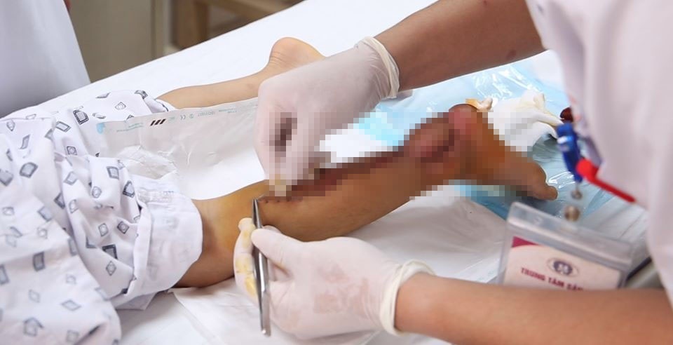 nan hoa xe đạp chém hổng gót chân ảnh 1 nan hoa xe dap chem hong got chan anh 1