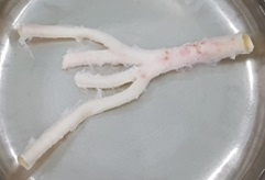 Be trai 8 tuoi duoc ghep dong mach tu nguoi chet nao hinh anh