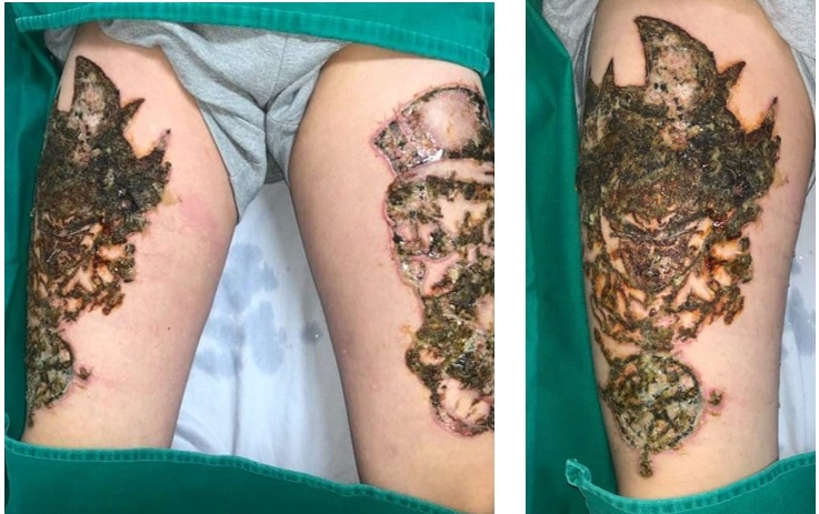 xóa xăm ảnh 1 xoa xam anh 1