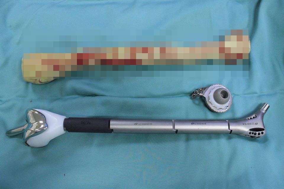 thay toàn bộ đoạn xương đùi  ảnh 1 thay toan bo doan xuong dui anh 1