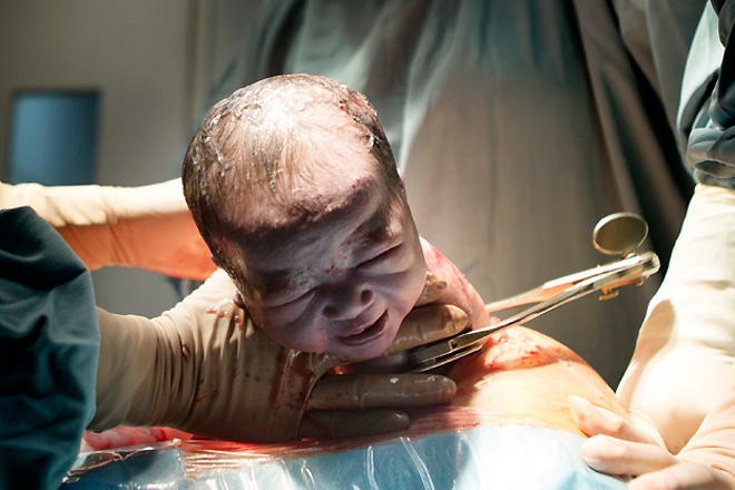 Can canh mot ca mo de o benh vien Viet Phap hinh anh