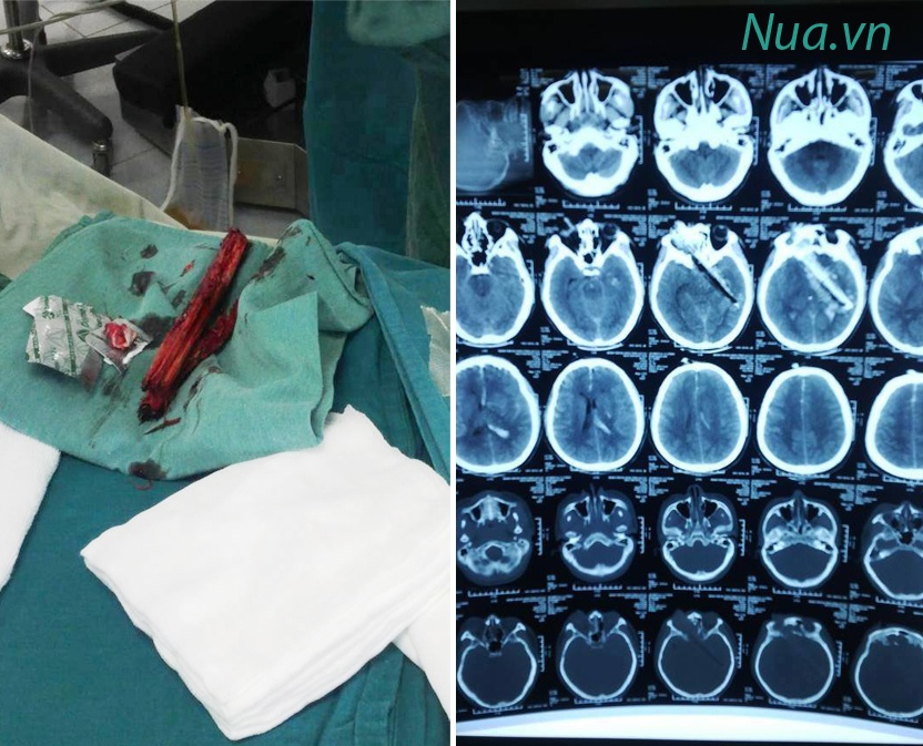 Nạn nhân Nguyễn Ngọc Tần (18 tuổi, Hà Nam), bị cây gỗ đâm vào đầu, chấn thương sọ não, mức độ nặng, rất nguy hiểm, được  tập thể các bác sĩ Lào Cai điều trị khẩn cấp, trong đó Thạc sĩ - bác sĩ Nguyễn Phú Duy trực tiếp phẫu thuật.