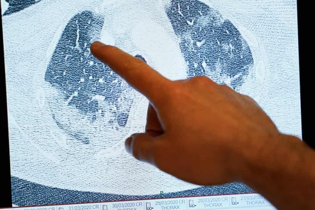 Di chung tren phoi o benh nhan Covid-19 sau nhieu tuan xuat vien hinh anh