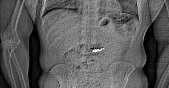 Nghi pham nuot tang vat tri gia hang tram nghin USD vao bung hinh anh