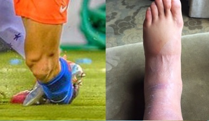 Mat ca chan cua Alexis Sanchez sung phong kinh di hinh anh