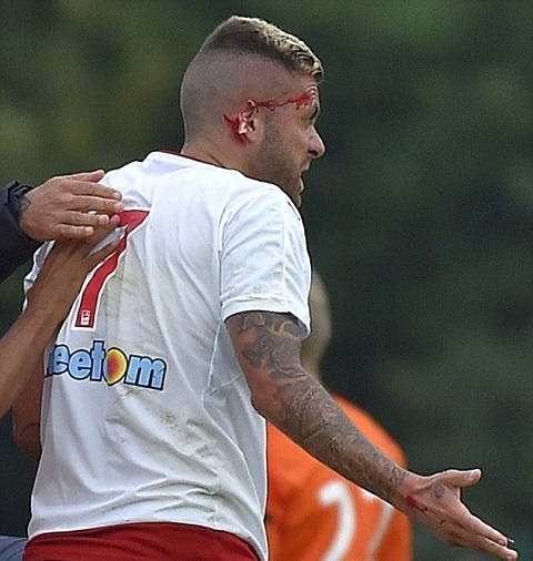 Menez bị giẫm đứt tai ảnh 2 Menez bi giam dut tai anh 2