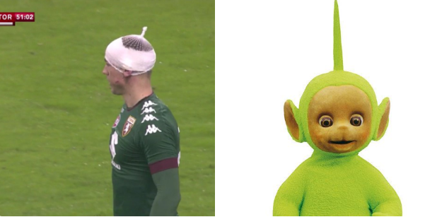 Joe Hart bị sưng mặt ảnh 5 Joe Hart bi sung mat anh 5