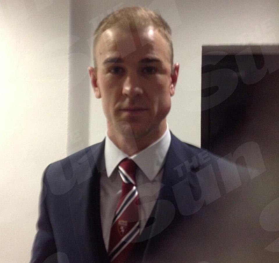 Joe Hart bị sưng mặt ảnh 1 Joe Hart bi sung mat anh 1