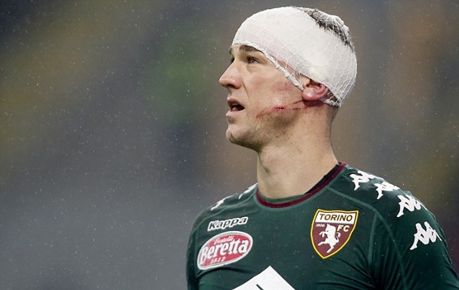 Joe Hart bị sưng mặt ảnh 2 Joe Hart bi sung mat anh 2