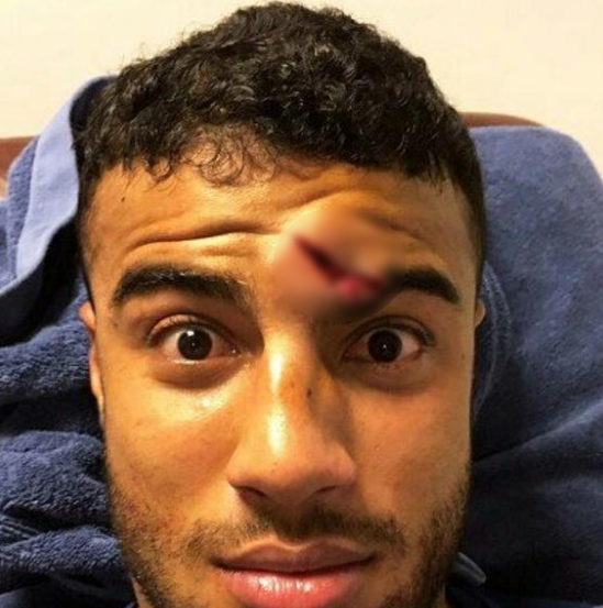 Rafinha dính chấn thương ở trán ảnh 2 Rafinha dinh chan thuong o tran anh 2