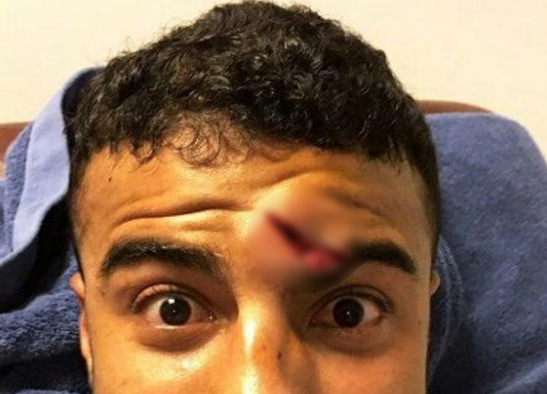 Tien ve Barca dinh chan thuong rung ron hinh anh