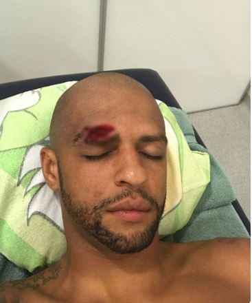chấn thương của Felipe Melo ảnh 2 chan thuong cua Felipe Melo anh 2